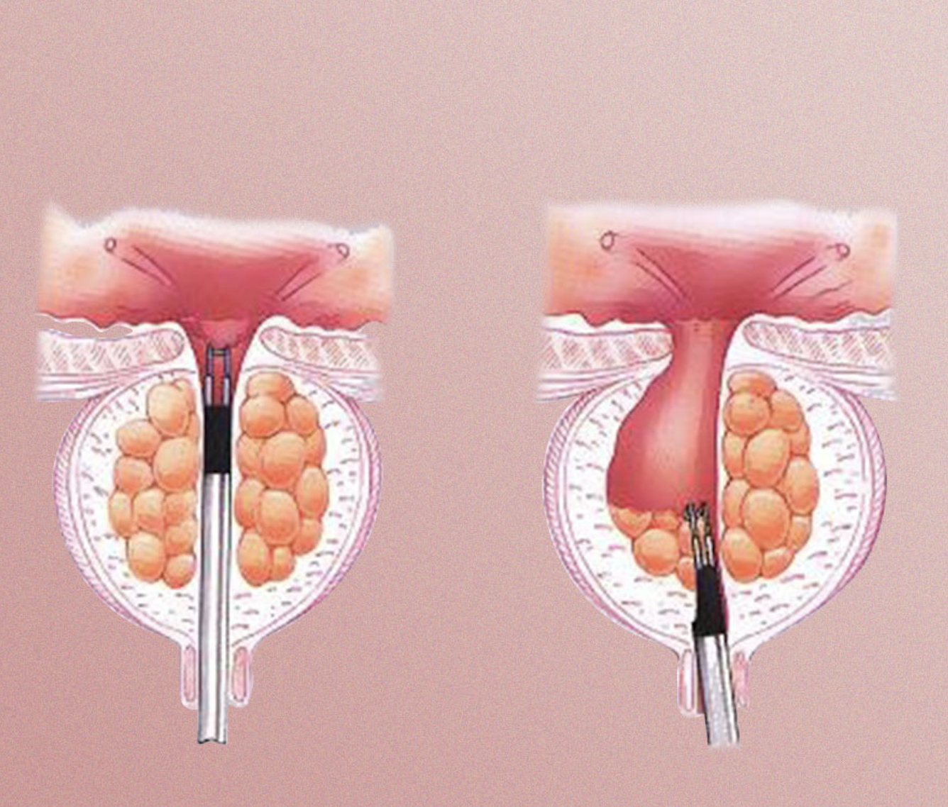 Comparação entre colocação padrão e colocação poupadora do ápex prostático durante a enucleação