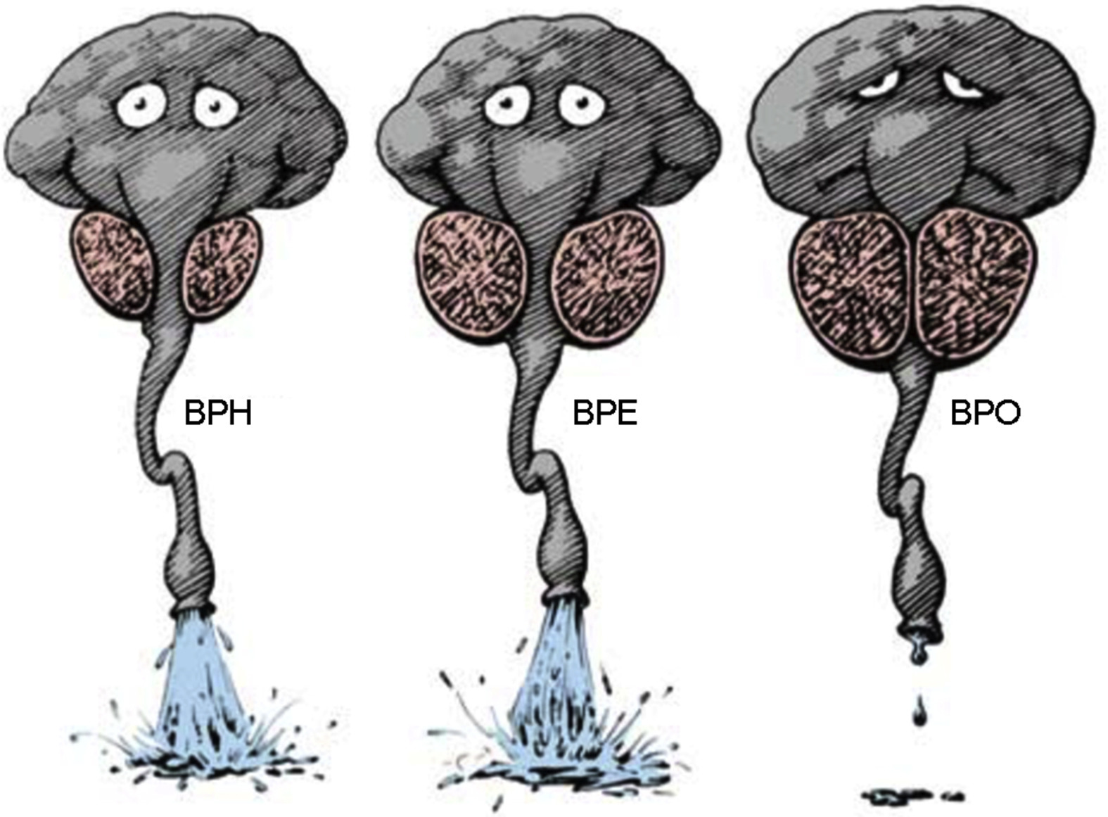 Diferença entre HBP, aumento prostático e obstrução prostática